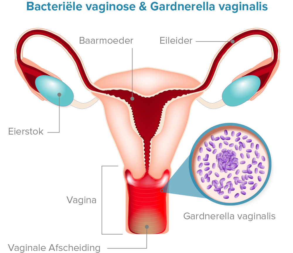 Bacteriële vaginose & Gardnerella vaginalis Diagram
