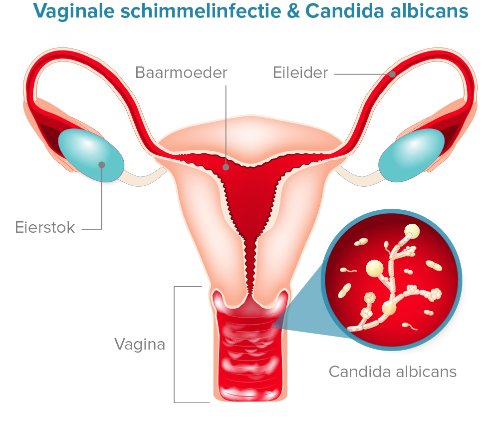 Vaginale schimmelinfectie & Candida albicans Diagram
